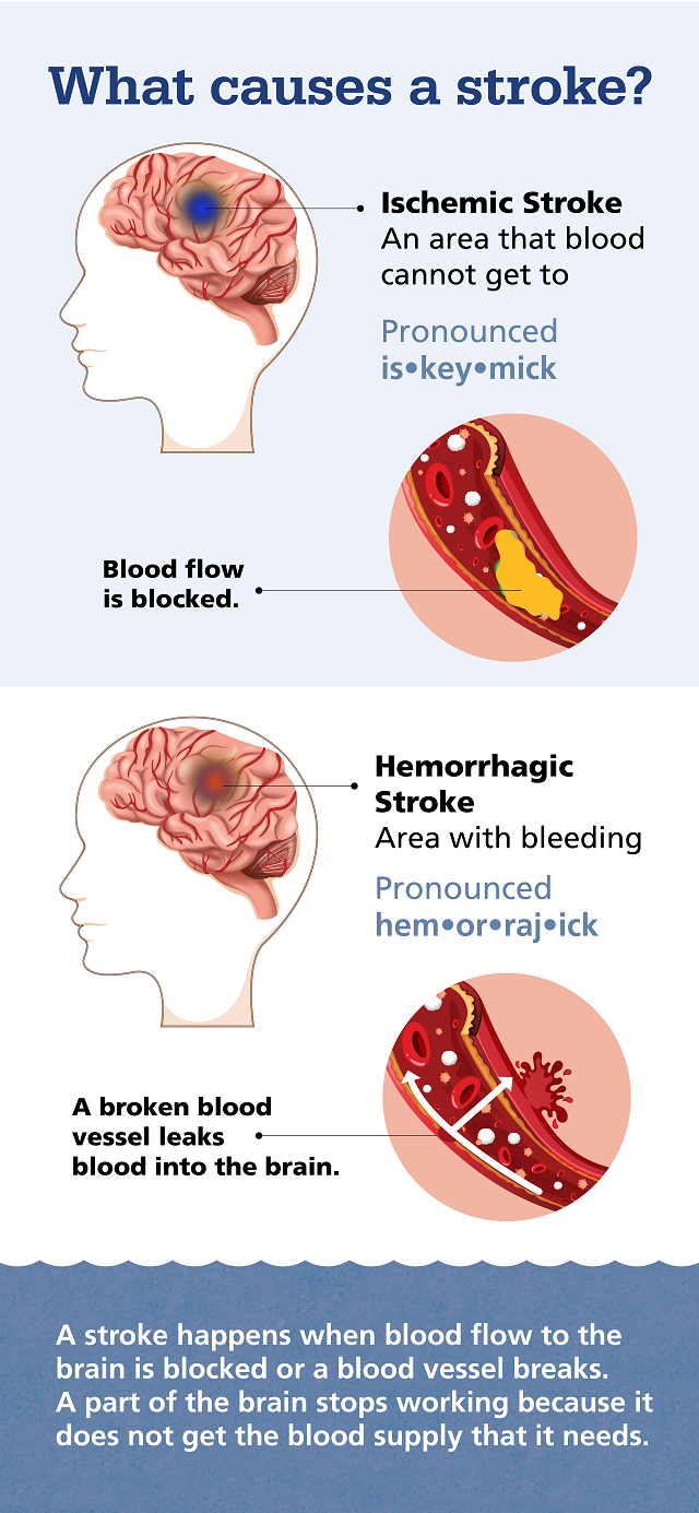 Graphic depicts two types of stroke